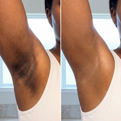 Dark Underarms