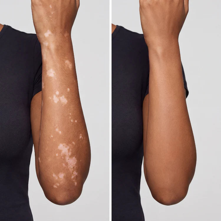 Vitiligo