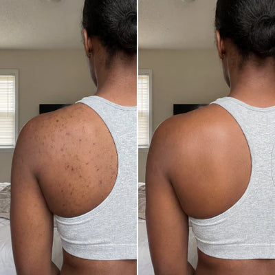 Back Acne