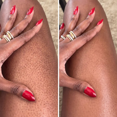 Strawberry Legs