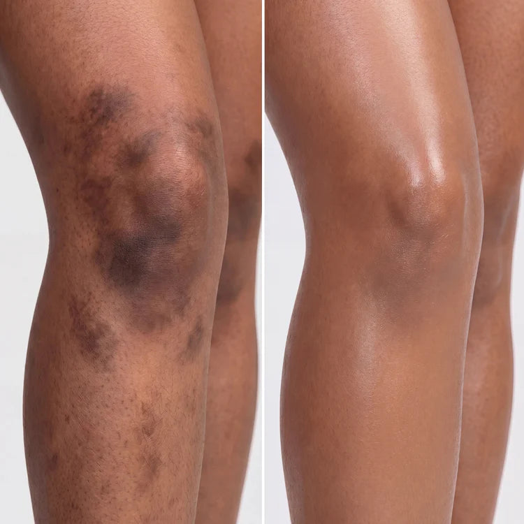 Hyperpigmentation