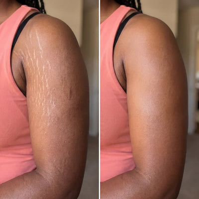 Stretch Marks